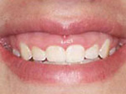 Cosmetic Periodontal Surgery - Before