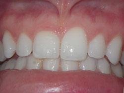 Cosmetic Periodontal Surgery