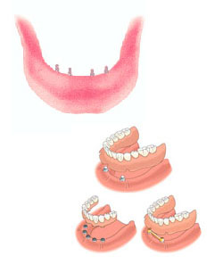 Implant Supported Dentures