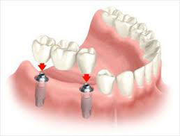 Implant Supported Bridge