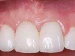 Functional Crown Lengthening-After