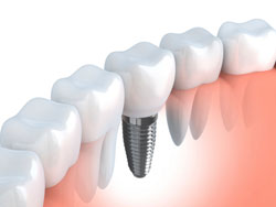 Implant Maintenance