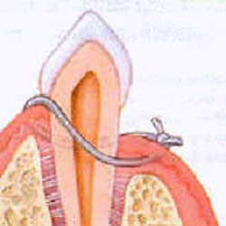 Osseous - After