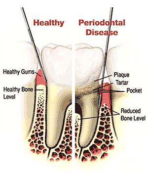 Periodontal Disease