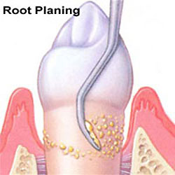 Root Planing