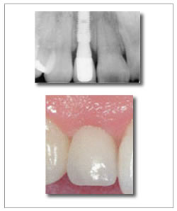 Single Tooth Implant