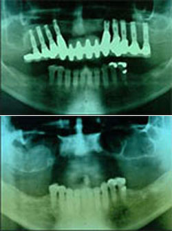 Sinus Lift