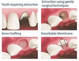 socket preservation