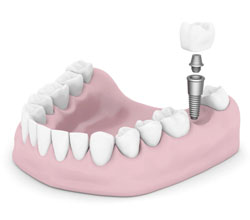 Dental Implants